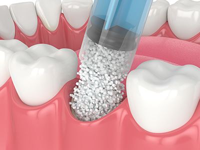 The image shows a close-up view of a dental implant being placed into a tooth cavity filled with dental cement, with a small amount of white powder visible on the implant.