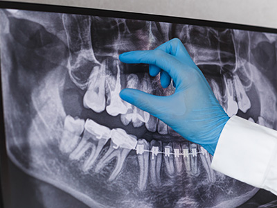 A person in medical attire closely examining a dental X-ray with a magnifying glass.