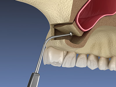 The image shows a dental drill being used on a tooth during a dental procedure.