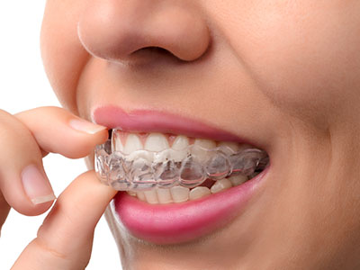 The image shows a person with a clear retainer on their teeth, holding the retainer up to their mouth while looking down at it.