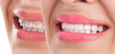 The image features a woman with her mouth open wide, displaying a bright smile with teeth whitening.