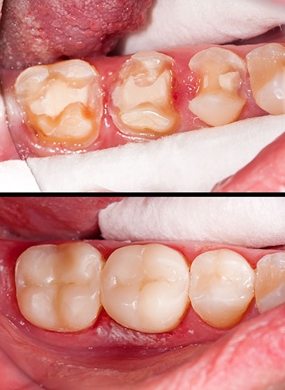 The image shows a close-up view of a person s mouth with an upper denture, displaying a yellowish discoloration on the teeth, and below, a lower set of teeth showing signs of decay and gum disease.