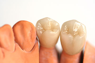 The image shows two sets of dental implants with teeth crowns, placed side by side against a white background.
