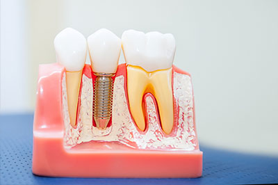 The image shows a model of human teeth with visible dental implants and screws, set against a blue background.