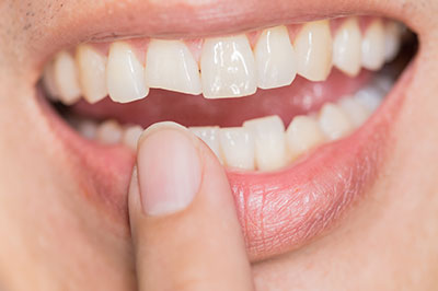 The image shows a close-up of a person s mouth with teeth showing, holding a finger near their lips, and there appears to be a dark substance on one tooth.
