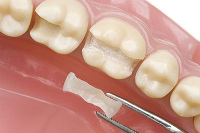 An image of a dental implant being placed into a tooth socket with dental tools visible.