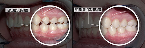 The image shows a side-by-side comparison of a person s teeth before and after dental treatment, highlighting the transformation from malocclusion to normal occlusion.