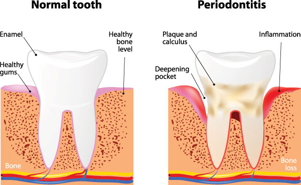 The image depicts a diagrammatic representation of a human tooth with annotations indicating different parts of the tooth structure, including normal tooth, periodontitis, bone loss, healthy gum, and inflammation.
