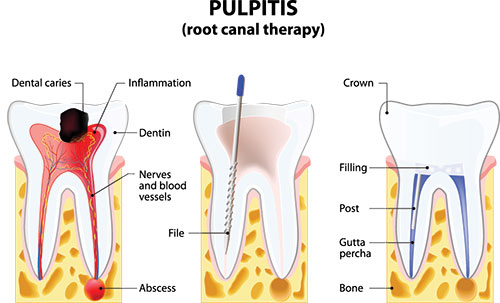 The image displays a detailed medical illustration showing the internal structures of a tooth, including the root canal therapy process, with annotations describing the various components such as dental caries, inflammation, and filling materials.