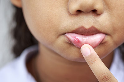The image shows a close-up of a person s face with a focus on their lips, which appear to be affected by a skin condition, possibly an infection or irritation, indicated by redness and swelling.
