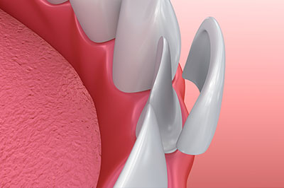 The image shows a close-up view of a dental implant with a screw visible on its surface, set against a soft pink background that resembles gum tissue.