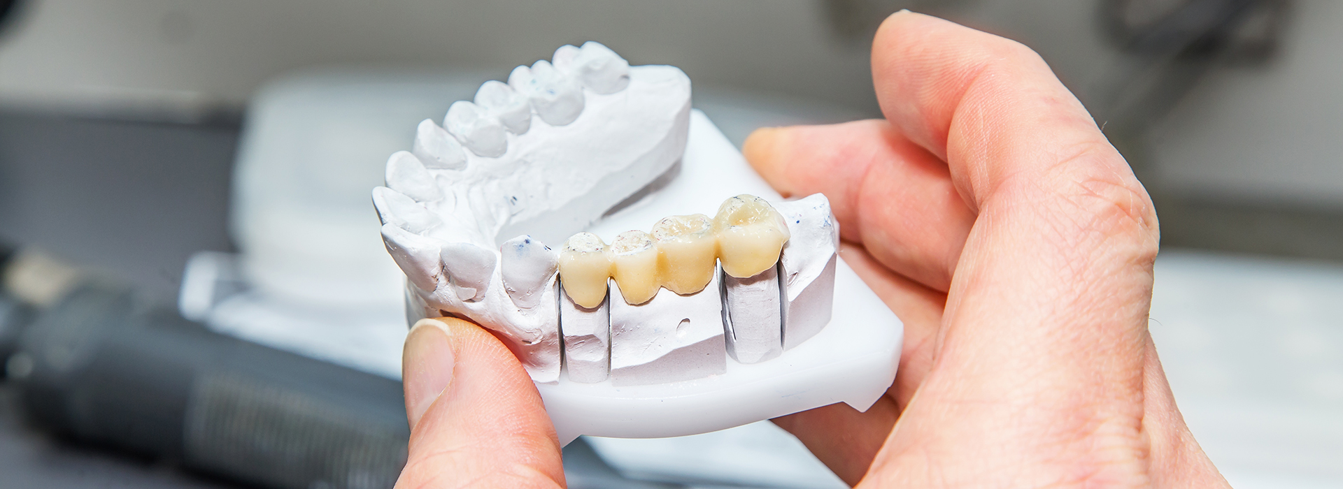 The image shows a person holding a set of dental implants with multiple teeth attached, ready for installation.