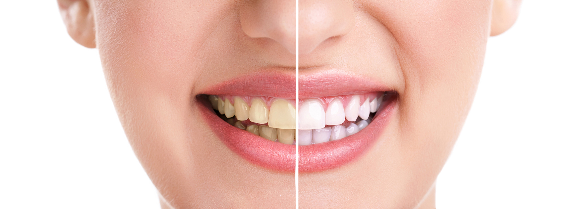 The image displays a close-up of a person s face with a focus on their teeth and mouth, highlighting dental care or oral health improvement through cosmetic procedures, such as teeth whitening or orthodontic treatment.