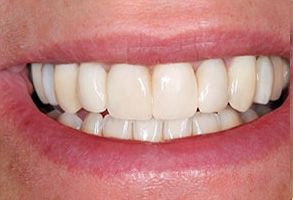 The image displays a close-up view of a person s smiling mouth with straight, white teeth.