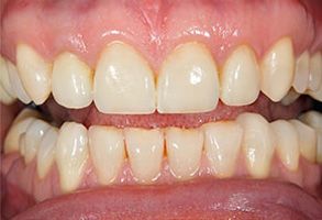 The image shows a close-up view of a person s teeth with yellowing and staining, indicating possible dental issues such as tooth decay or poor oral hygiene.