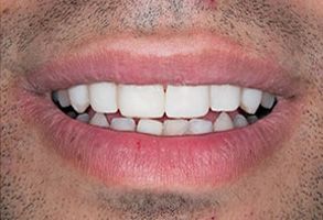 The image shows a close-up of a person s face with a smile, displaying teeth and lips, against a neutral background.