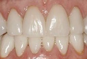 The image displays a close-up view of a person s teeth with a focus on the upper front teeth, showing a partial smile with some discoloration visible on the teeth.