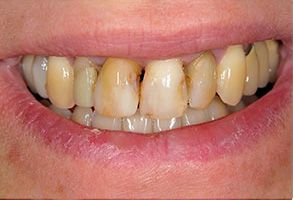 The image shows a close-up of a person s teeth with yellowing, indicating possible dental issues such as staining or decay.