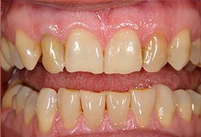 The image shows two views of a person s teeth with a focus on dental restoration procedures, including fillings and possibly crowns or veneers.
