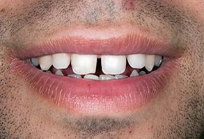 The image shows a close-up of a person s smiling face with a focus on their teeth, which are missing one tooth.