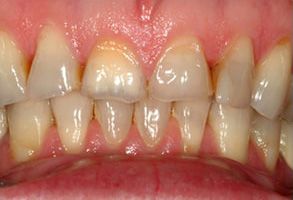 The image displays a close-up view of a person s teeth with yellow stains and some missing teeth, showcasing a dental condition or the need for oral care.