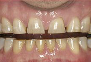 The image shows a close-up of a person s teeth with extensive discoloration, likely due to staining or decay, and a metal appliance holding the upper front teeth in place, possibly for orthodontic purposes.